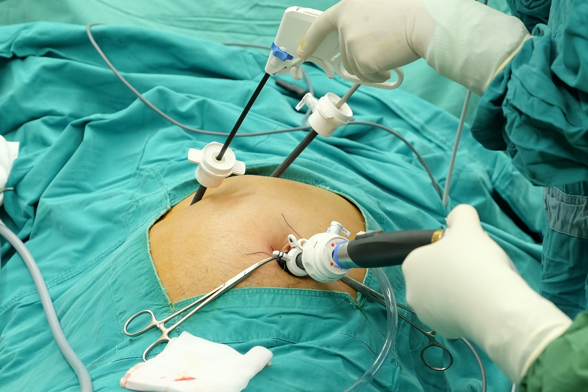 Laparoscopic Gall Bladder Surgery