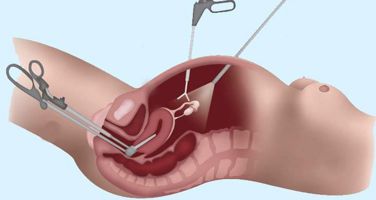 Hysterectomy Surgery Image 2
