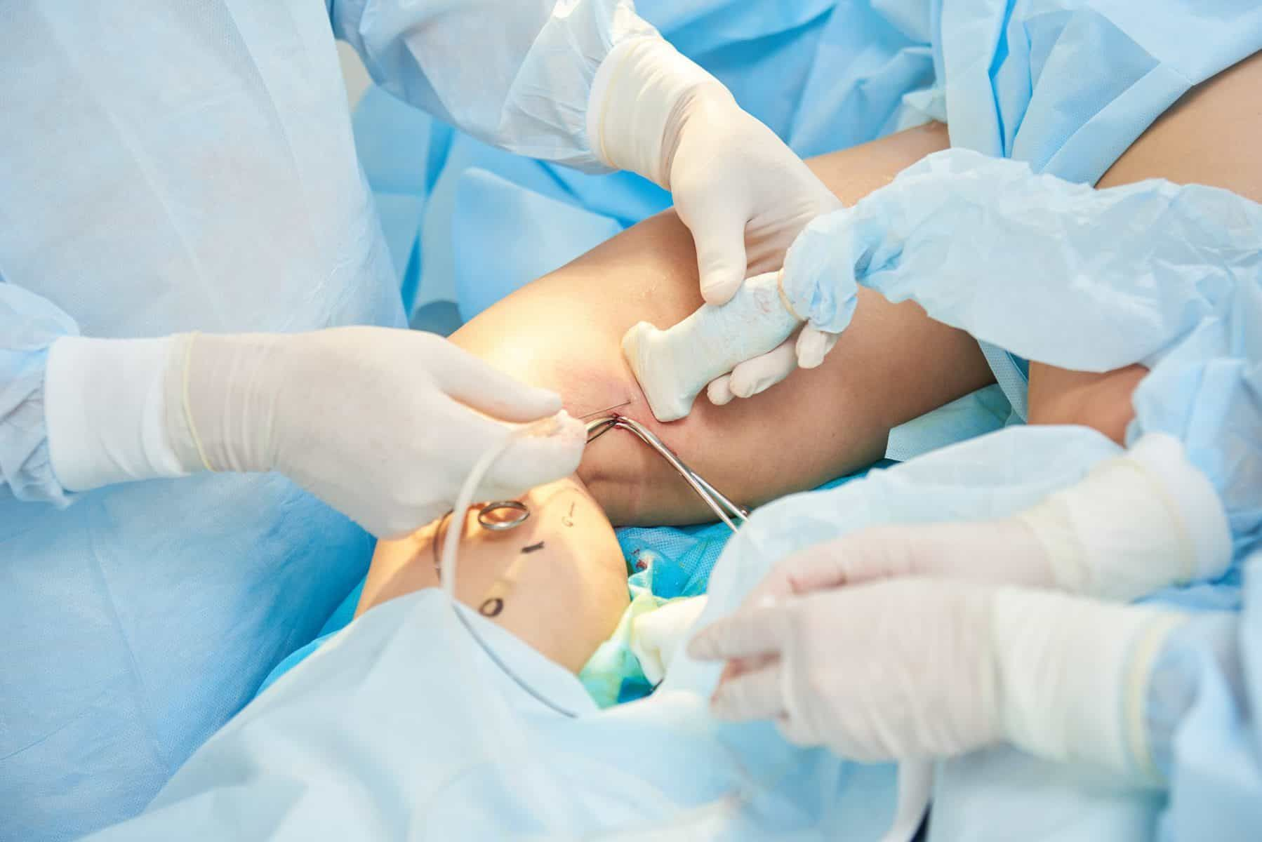 Varicose Veins Treatment